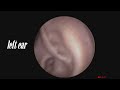 the normal ear passage without significant earwax