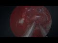 Endoscopic endonasal pituitary gland hemi-transposition for resection of a dorsum sellae meningioma