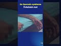 Shorts #65: The Finkelstein test for de Quervain tenosynovitis or syndrome - how it is done