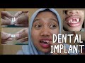 [DENTAL IMPLANT REVIEW #1] | Implant gigi sakit ngga sih?