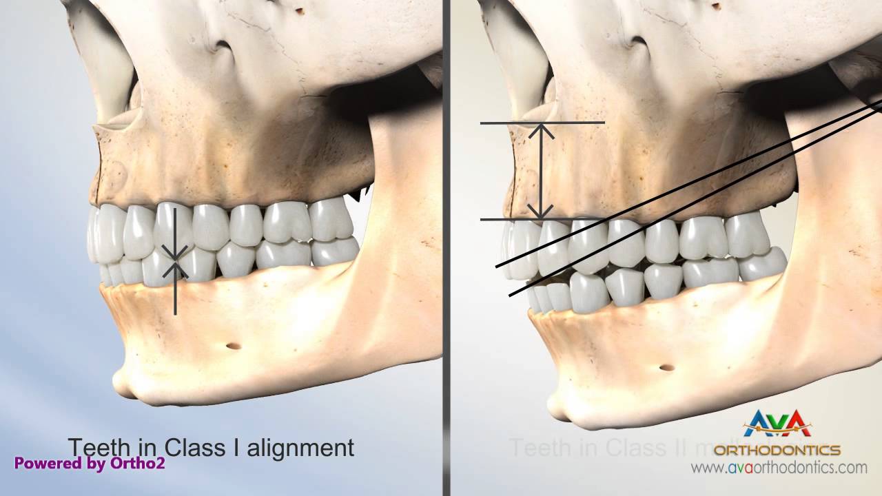 Overjet (AKA Overbite) Secondary To Vertical Maxillary Excess - Class ...