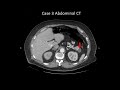 EUS diagnosis of cystic pancreatic neuroendocrine tumors