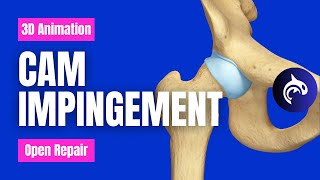 Cam Impingement Open Repair - 3D Animation (No Narration)