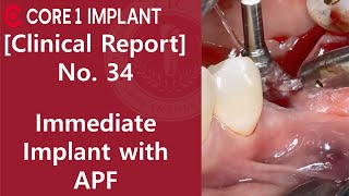 [CYBERMED Clinical Report] #35, 36 immediate implant placement with APF