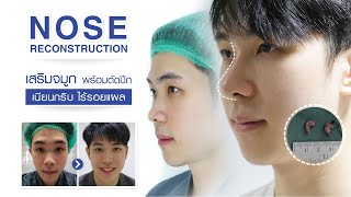 #เสริมจมูกตัดปีก #NoseReconstruction จมูกโด่งอย่างธรรมชาติ แผลเนียน