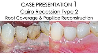 #Periodontology  #Perio  #MicroSurgery  #PeriodontalMicroSurgery YouTube　CASE1