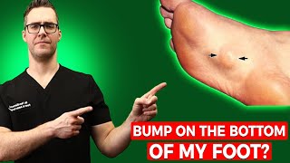 Bump on the Bottom of My Foot? [Plantar Fibroma Treatment & Massage!]