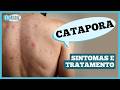 CATAPORA pode ser grave? E o que tem a ver com HERPES-ZÓSTER? #catapora #herpeszoster