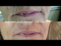 fibroblast lip before during after and healed