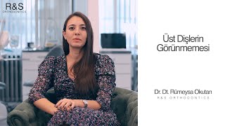 Üst Dişlerin Görünmemesi - Dr. Rümeysa Okutan