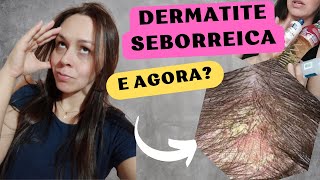 DERMATITE SEBORREICA -Solução caseira para CASPA e SEBORREIA!