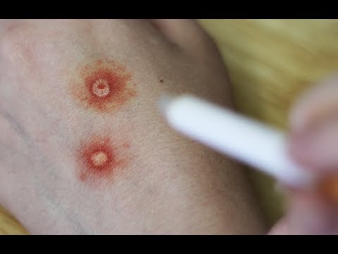 Cigarette Burn Cigarette Burn