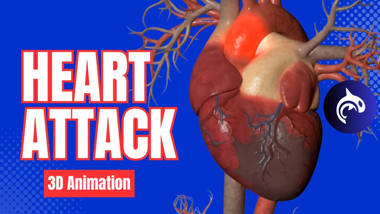 Heart Attack Myocardial Infarction 3d Animation Youtube
