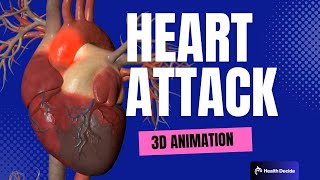 Heart Attack - Myocardial Infarction - 3D Animation