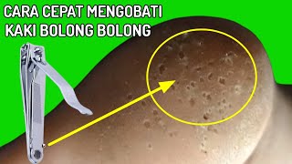 Cara Cepat Mengobati Kaki Bolong Bolong