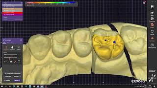 Exocad iniciante cad cam inlay onlay diferenças