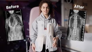 Scoliosis surgery using the Mazor X Stealth surgical robot: Emma's story