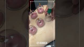 Cupping For Back Pain Relief | Sports Performance Physical Therapy