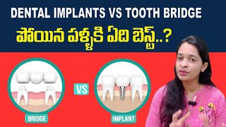 Dental Implants Vs Tooth Bridge in Telugu | Best option to replace missing teeth |