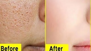 ওপেন পোরস দূর করার ঘরোয়া উপায় / Get Rid of Large Open Pores in 3 Days at Home \u0026 Get Glass Skin