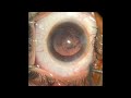 phaco surgery in a posterior subcapsular cataract with acryfold lens under topical anaesthesia