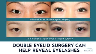 How Double Eyelid Surgery can Help Reveal Obscured Eyelashes