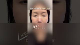 세포단위 눈밑 지방이식 내돈내산 후기 비포 애프터 눈밑지 부작용으로 눈밑지이