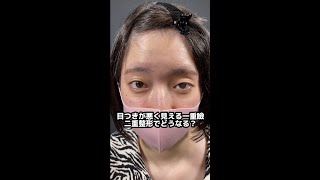 【二重整形】術後可愛すぎる、、、#shorts