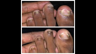 BIG TOE READY TO EXPLODE! WATCH WHAT HAPPENS NEXT