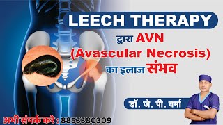 LEECH THERAPY द्वारा AVN (Avascular Necrosis)  का इलाज संभव by Dr. J.P. Verma