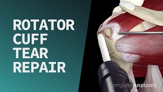 Rotator Cuff Tear Repair