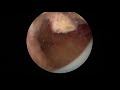 hysteroscopic polypectomy no edit