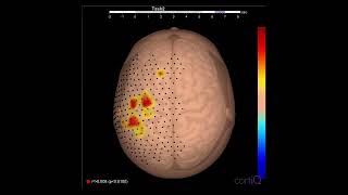 Individual Finger Movement Decoding Using g.Pangolin Ultra High-Density EEG System