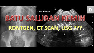 Gambaran Radiologi Batu Saluran Kemih. Rontgen, USG, CT scan !!!