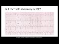 SVT with Aberrancy or VT?