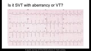 SVT with Aberrancy or VT?