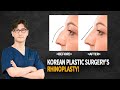 Asian Rhinoplasty | Nose job | Before After