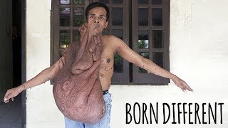 My 30kg Tumours Won't Stop Growing | BORN DIFFERENT