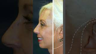 Natural Facelift RESULTS - Dr. Scott Holley - West Michigan Plastic Surgery #beforeandafter