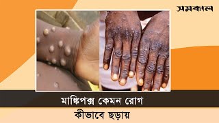 মাঙ্কিপক্স কেমন রোগ, কীভাবে ছড়ায় | Samakal News