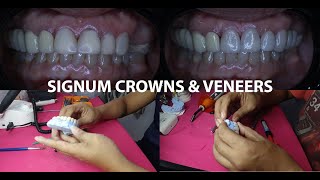 SIGNUM CROWN AND VENEERS | DENTAL PHILIPPINES