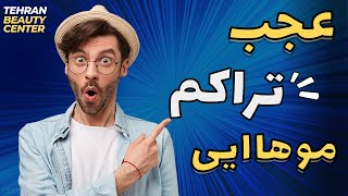 رضایت زیباجوی عزیزمون از کاشت مو فول تراکم در کلینیک تخصصی تهران بیوتی سنتر