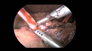 Laparoscopic Excision of Type Ic Choledochal Cyst Including Intrapancreatic Portion with Hepaticojej