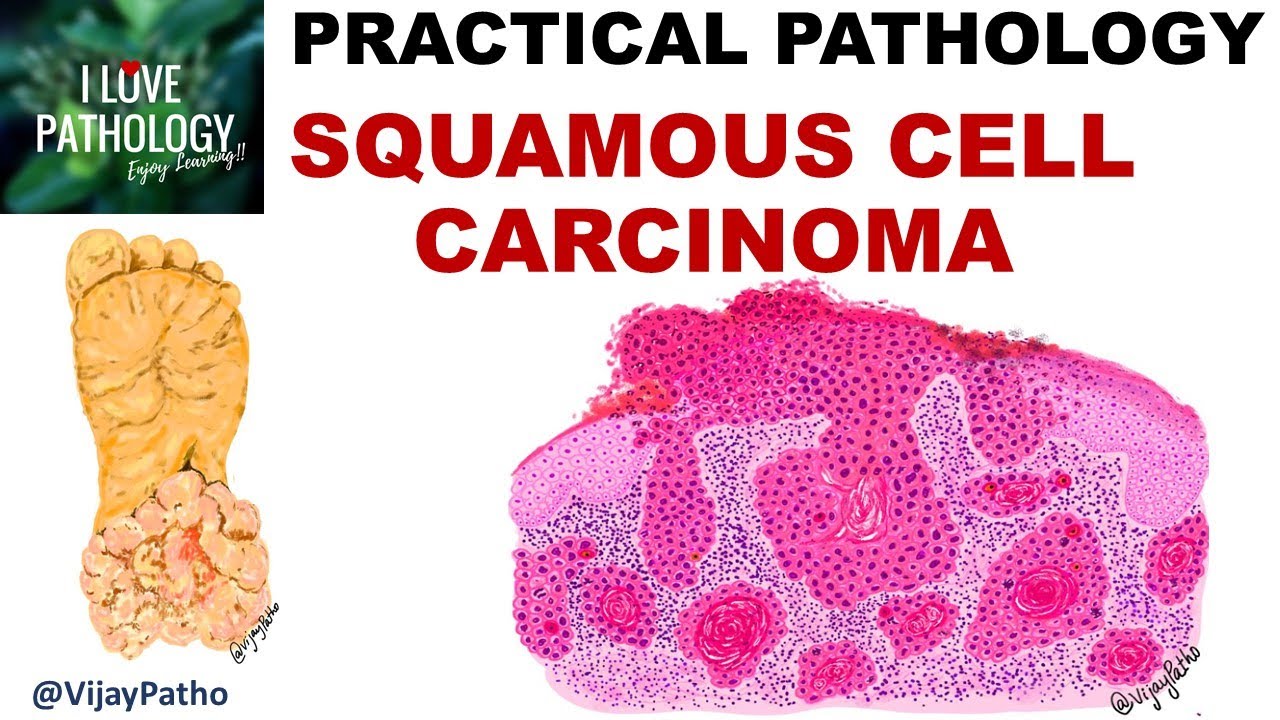 SQUAMOUS CELL CARCINOMA: Clinical Features & Morphology; Premalignant ...