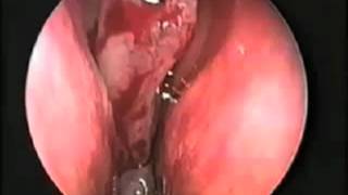 Endoscopic Removal of a Juvenile Nasal Angiofibroma | UCLA