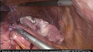 Laparoscopic hand-sewn palliative GEA (gastro-entero anastomosis)  with EEA.