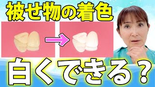 歯を白くして被せ物の着色も綺麗にしたい！効果的な方法を歯医者が解説？