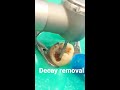 decay removal toothdecay decay toothache shorts teethfacts