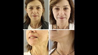 Total Face Makeover με 3 συνδυαστικές θεραπείες