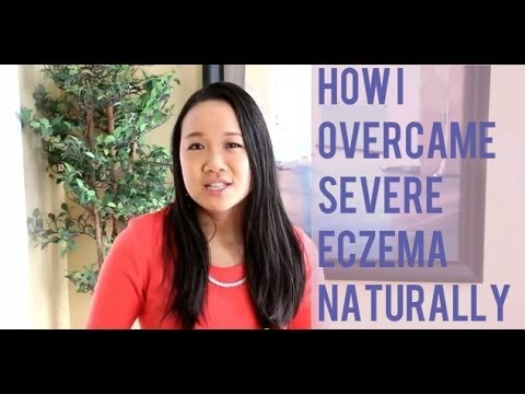 How I Overcame Severe Eczema Naturally How I Overcame Severe Eczema Naturally